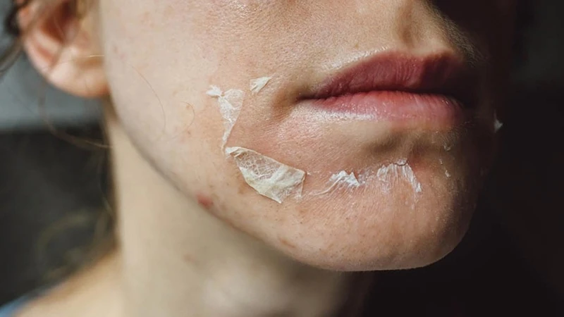 Fine light flaking after a peel, illustrating whether a peel causes peeling