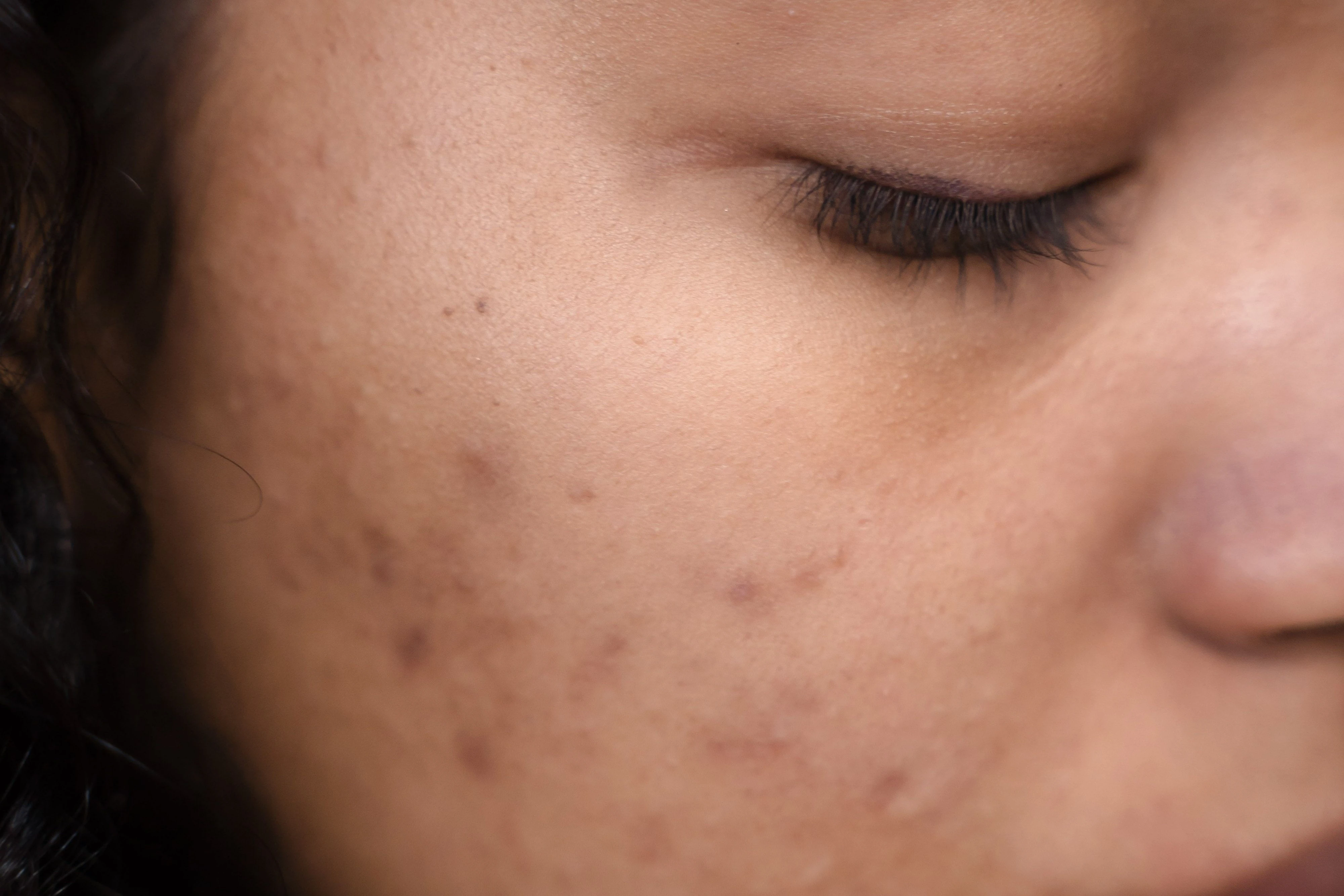 Close-up of a breakout-prone skin area, a common sight after a facial