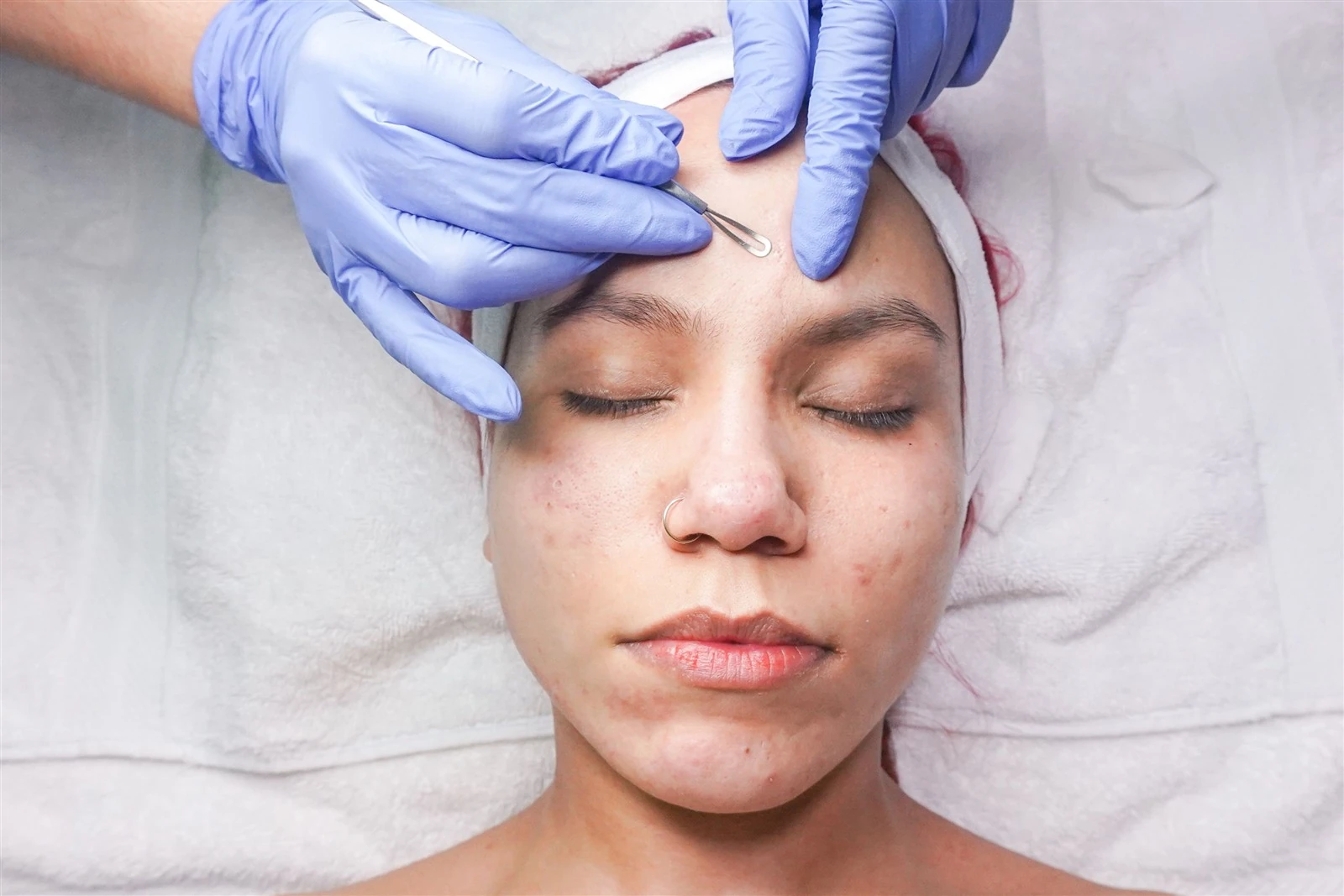 A specialist treating a breakout spot with control, rather than working over the whole face