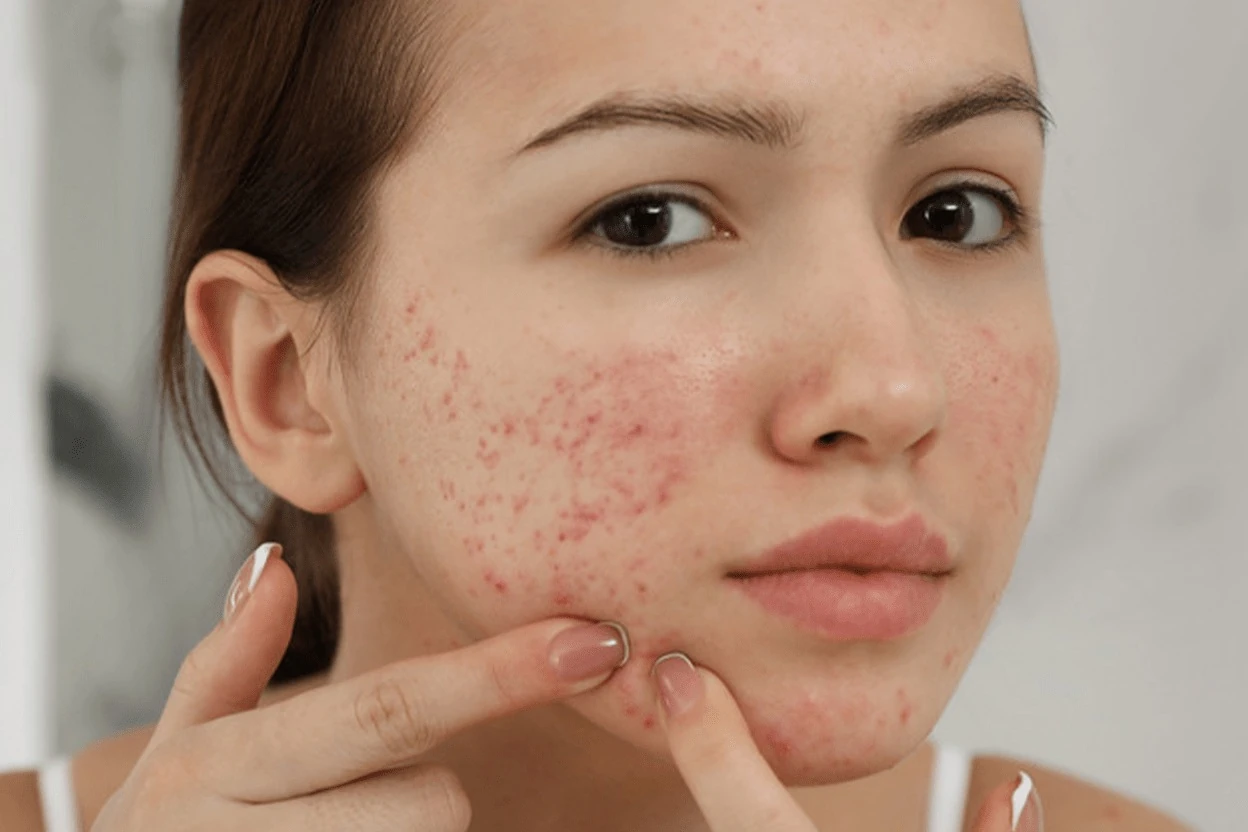 Do not squeeze breakouts after a facial, which can cause inflammation, dark marks and scarring in breakout-prone skin