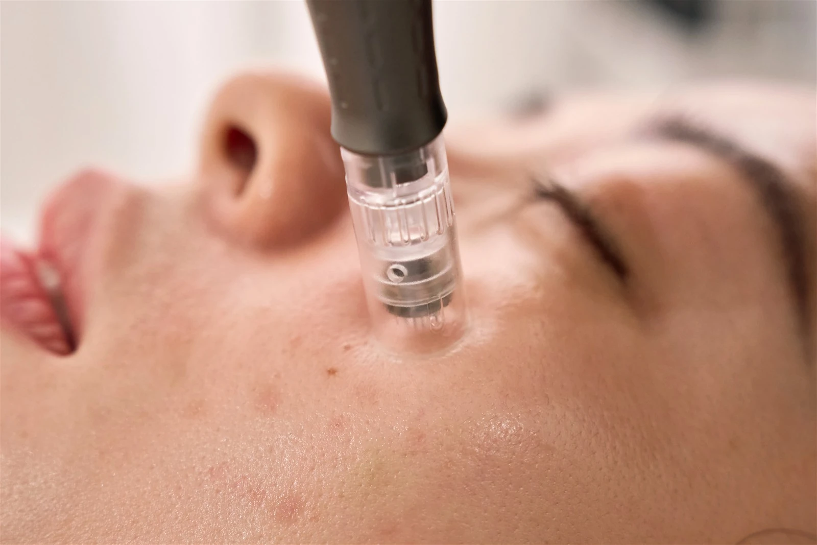A nano tip gliding gently over the skin, the method of nanoinfusion